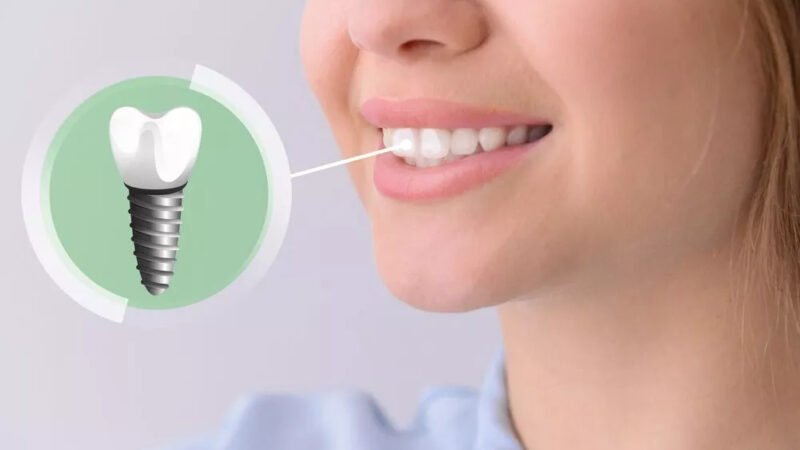 Dental Implants in Tbilisi