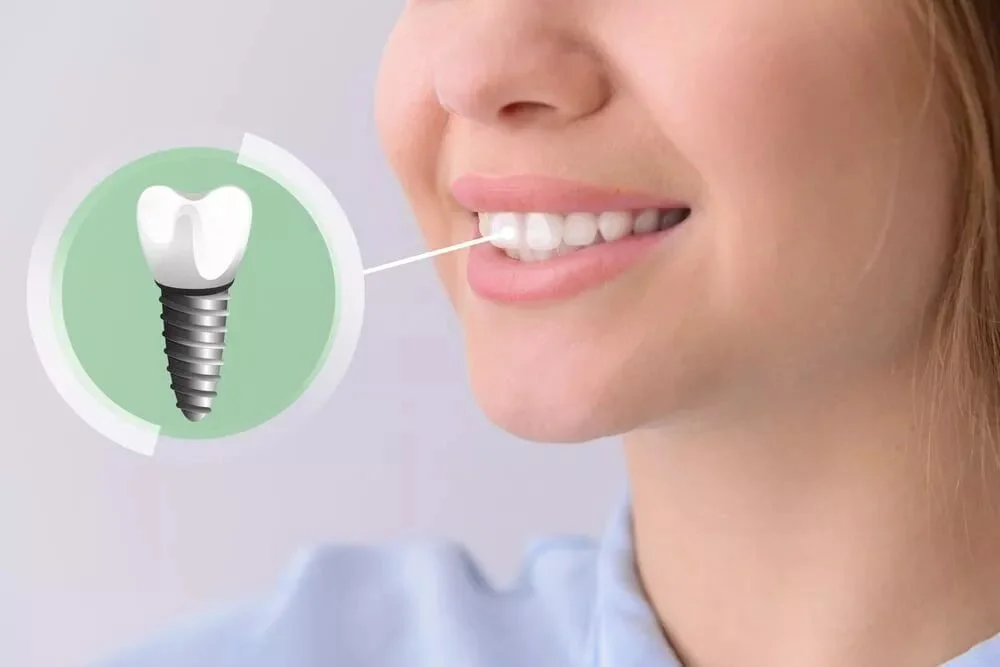 Home 25 Dental Implants in Tbilisi